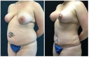 21650b56fda7bbb17d5 - Breast Lift Augmentation Before And After - Fairfax and Manassas VA
