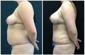 21650c56fda7bbcbf09 - Breast Lift Augmentation Before And After - Fairfax and Manassas VA