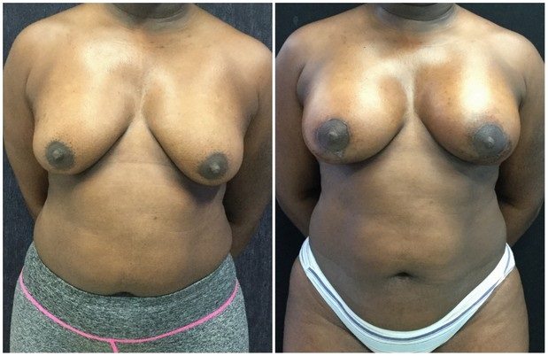 22004a - Breast Lift Augmentation Before And After - Fairfax and Manassas VA