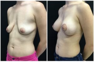 22062b - Breast Lift Augmentation Before And After - Fairfax and Manassas VA