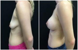 22062c - Breast Lift Augmentation Before And After - Fairfax and Manassas VA