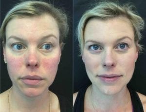 BBL Photo Rejuvenation - Before And After | Fairfax VA