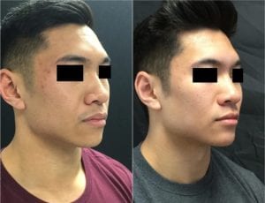 22858-20170331_90-Draw58deb85e8da9e-non-surgical-chin-augmentation - Non-Surgical Cheek Augmentation - Before And After | Fairfax and Manassas VA