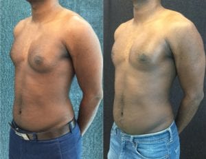 22934-20171213_Canvas2 - Male Breast Reduction - Before And After - Gynecomastia - Fairfax VA
