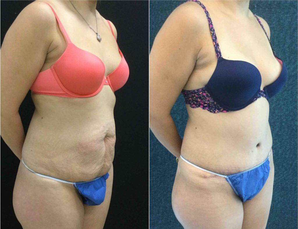 -24174-20171212_Canva2s - Tummy Tuck & Abdominoplasty - Before And After - Fairfax VA