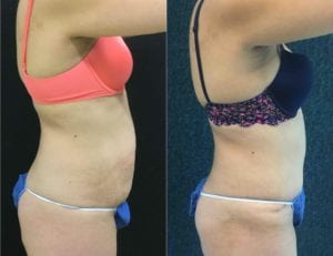 -24174-20171212_Canvas - Tummy Tuck & Abdominoplasty - Before And After - Fairfax VA