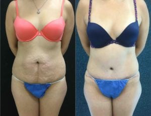 -24174-20171212_Canvasfront - Tummy Tuck & Abdominoplasty - Before And After