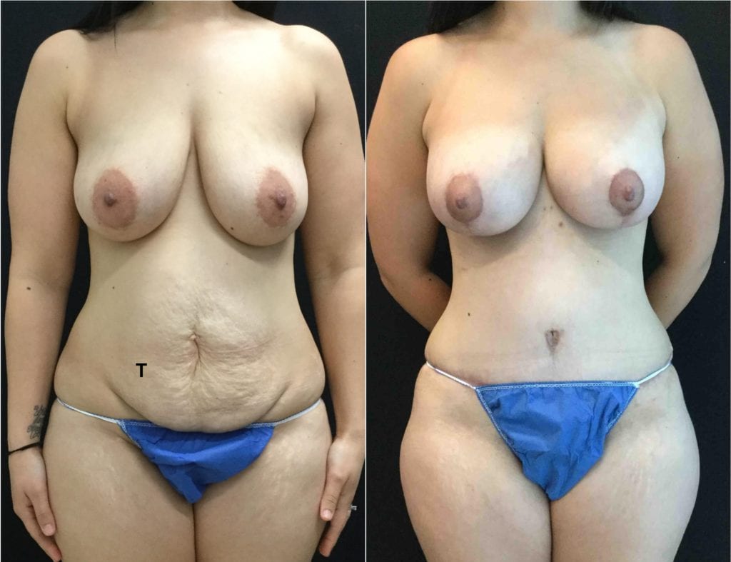 24918-20170612_Front-2-Canvas - Breast Lift Augmentation Before And After - Fairfax and Manassas VA