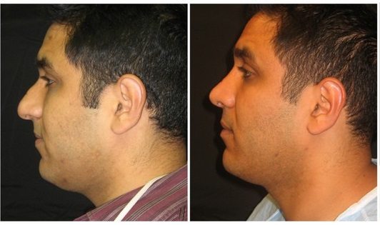 2545b - Rhinoplasty for Men Before and After | Fairfax and Manassas VA