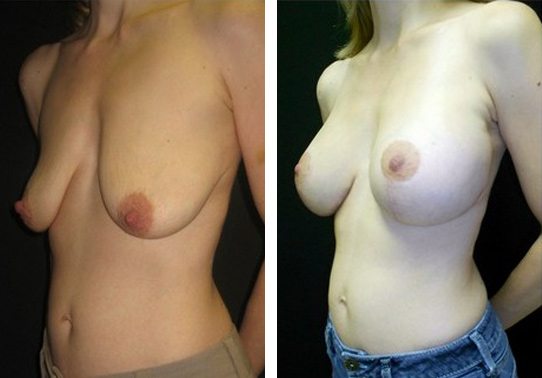 4123-front - Breast Lift Augmentation Before And After - Fairfax and Manassas VA