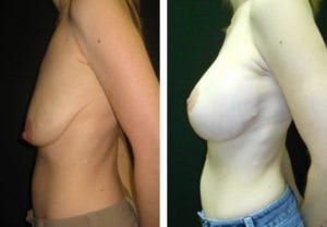 4123-side - Breast Lift Augmentation Before And After - Fairfax and Manassas VA