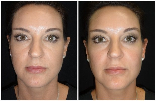 551a-voluma - Non-Surgical Cheek Augmentation - Before And After | Fairfax and Manassas VA