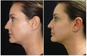 551c-voluma - Non-Surgical Cheek Augmentation - Before And After | Fairfax and Manassas VA