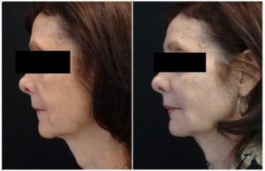 7582c-voluma - Non-Surgical Cheek Augmentation - Before And After | Fairfax and Manassas VA