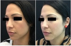 8747bbb-voluma - Non-Surgical Cheek Augmentation - Before And After | Fairfax and Manassas VA