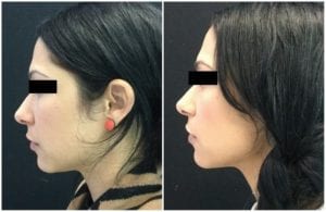 8747cc-voluma - Non-Surgical Cheek Augmentation - Before And After | Fairfax and Manassas VA