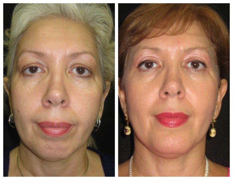 8833 - Eyelid Lift Before and After | Fairfax and Manassas VA