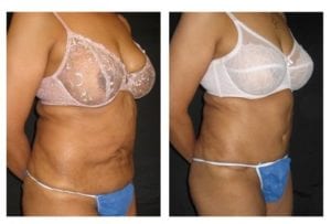 9117b - Tummy Tuck Before and After | Fairfax and Manassas VA