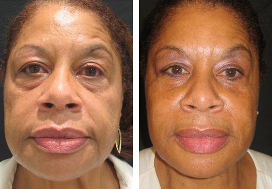9674-fontview527114ed56164-non-surgical-facelift - Non-Surgical Cheek Augmentation - Before And After | Fairfax and Manassas VA