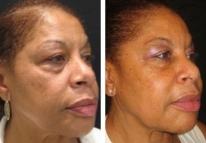 9674-sideview527114ec6c8a4-non-surgical-facelift - Non-Surgical Cheek Augmentation - Before And After | Fairfax and Manassas VA