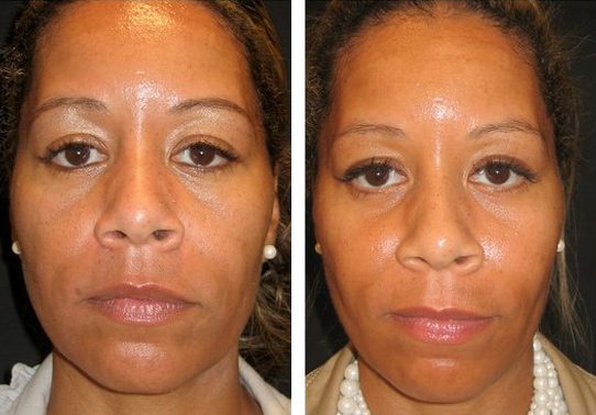 9675-frontview527114edc75f7-non-surgical-facelift - Non-Surgical Cheek Augmentation - Before And After | Fairfax and Manassas VA