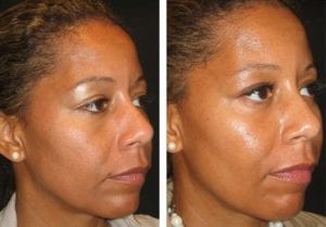 9675-sideview-2527114ee47721-non-surgical-facelift - Non-Surgical Cheek Augmentation - Before And After | Fairfax and Manassas VA