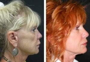 9829-radiesse - Non-Surgical Cheek Augmentation - Before And After | Fairfax and Manassas VA