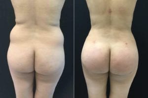 Before & After - Brazilian Butt Lift Straight View - Bitar Cosmetic Institute | Fairfax and Manassas VA