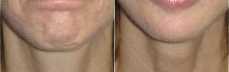Chin-Botox-Patient-15-botox-2 - Botox - Before And After | Fairfax and Manassas VA