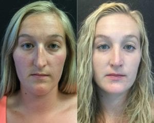 FRONT-20826 - Rhinoplasty Before and After | Fairfax and Manassas VA