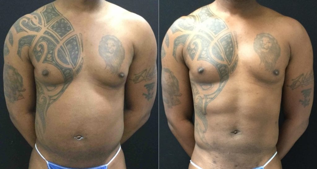 FRONT-21164 - Abdominal Etching Before and After | Fairfax and Manassas VA
