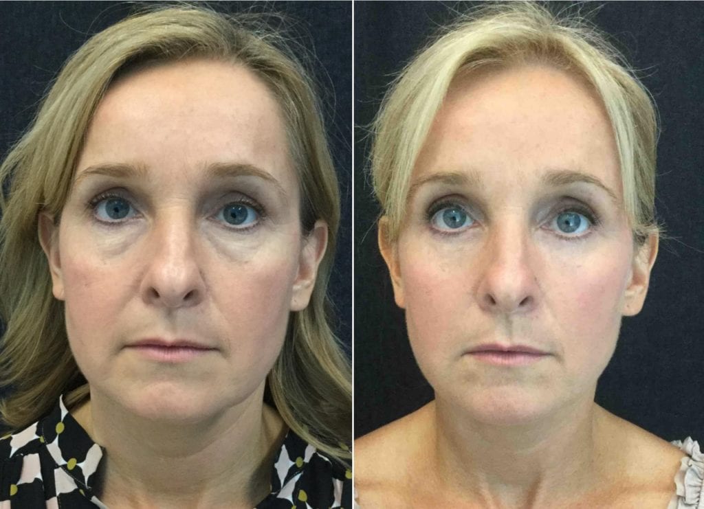 FRONT-24134 - Eyelid Lift Before and After | Fairfax and Manassas VA