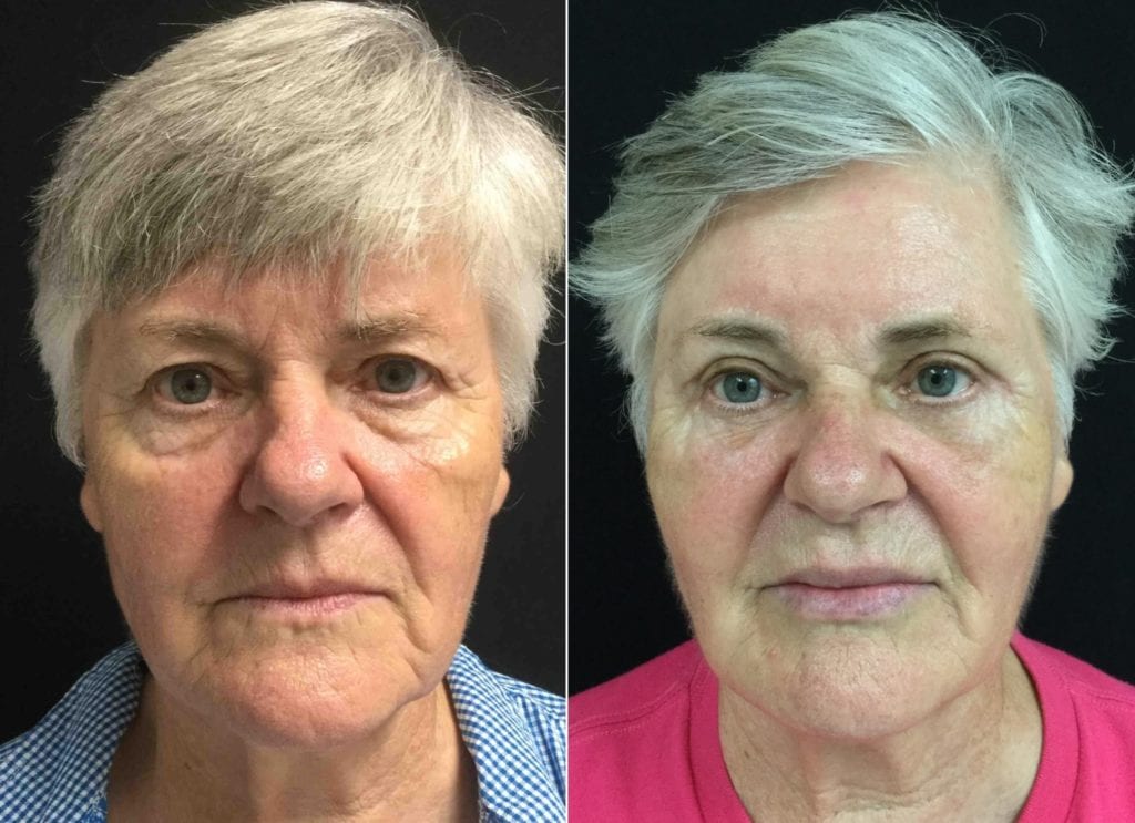 FRONT-25284 - Eyelid Lift Before and After | Fairfax and Manassas VA