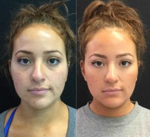 FRONT25122- - Restylane Before and After | Fairfax and Manassas VA
