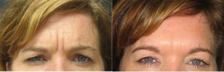 Frown-Line-Botox-Patient-12-botox-2 - Botox - Before And After | Fairfax and Manassas VA