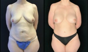  - Breast augmentation and lift before and after photos front view