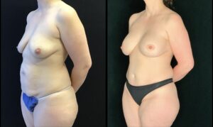  - Breast Augmentation and lift before and after photos