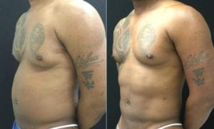 L ANGLE-21164 - Abdominal Etching Before and After | Fairfax and Manassas VA