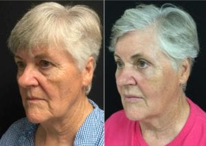 L45 -25284 - Eyelid Lift Before and After | Fairfax and Manassas VA