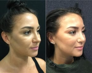 New Angle-25532 - Before and After - Rhinoplasty For Women Angled 2 - Bitar Cosmetic Institute