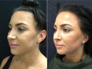 New R Angle-25532 - Before and After - Rhinoplasty For Women Angled - Bitar Cosmetic Institute