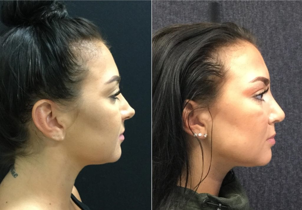 New R Profile-25532 - Before and After - Rhinoplasty For Women - Bitar Cosmetic Institute | Fairfax and Manassas VA