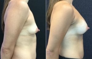 PROFILE R-21926 - Breast Augmentation Before And After - Fairfax and Manassas VA