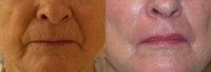 Lip Lift - Before And After - Fairfax and Manassas VA