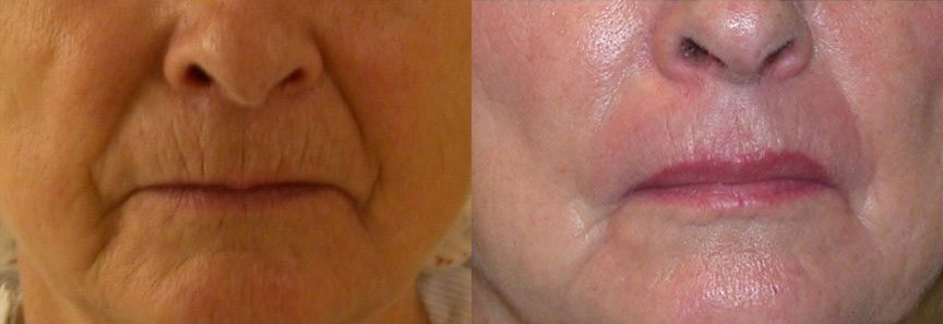 Patient-001527011719ee8d-lip-lift-2 - Lip Lift - Before And After - Fairfax and Manassas VA