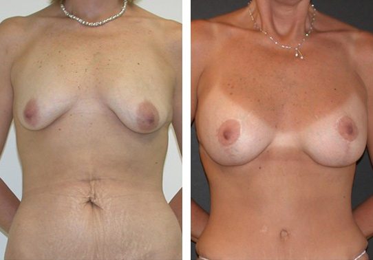 Patient-002a527027e5e6a28 - Breast Lift Augmentation Before And After - Fairfax and Manassas VA