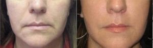Restylane Lyft - Before And After | Fairfax and Manassas VA
