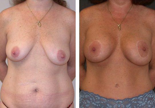 Patient-003a527027e73c30d - Breast Lift Augmentation Before And After - Fairfax and Manassas VA