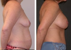 Patient-003b527027eaf0e37 - Breast Lift Augmentation Before And After - Fairfax and Manassas VA