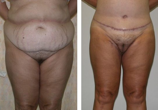 Patient-00452710dd054311 - Thigh Lift Before and After | Fairfax and Manassas VA